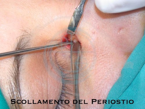 Ostruzione vie lacrimali 2.3