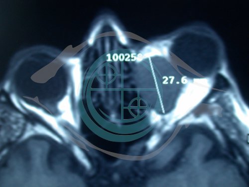 Tumori dell’Orbita 1
