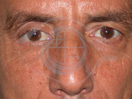 Tumori dell’Orbita 10