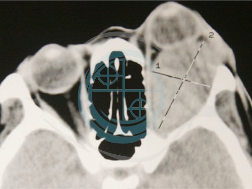 Tumori dell’Orbita 11