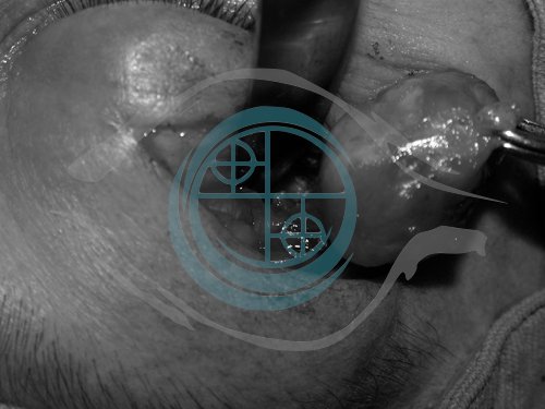 Tumori dell’Orbita 16