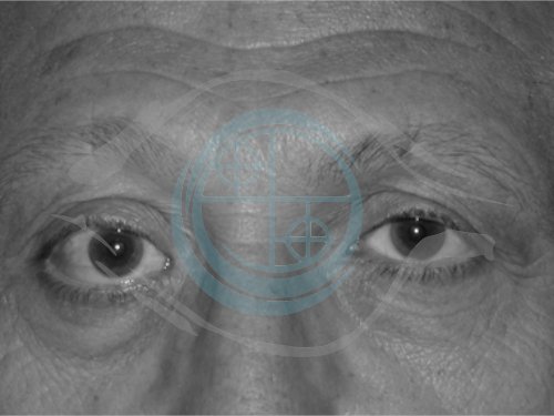 Tumori dell’Orbita 17