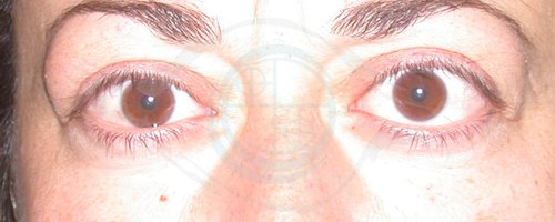 Tumori dell’Orbita 26