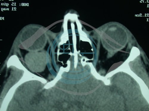 Tumori dell’Orbita 4