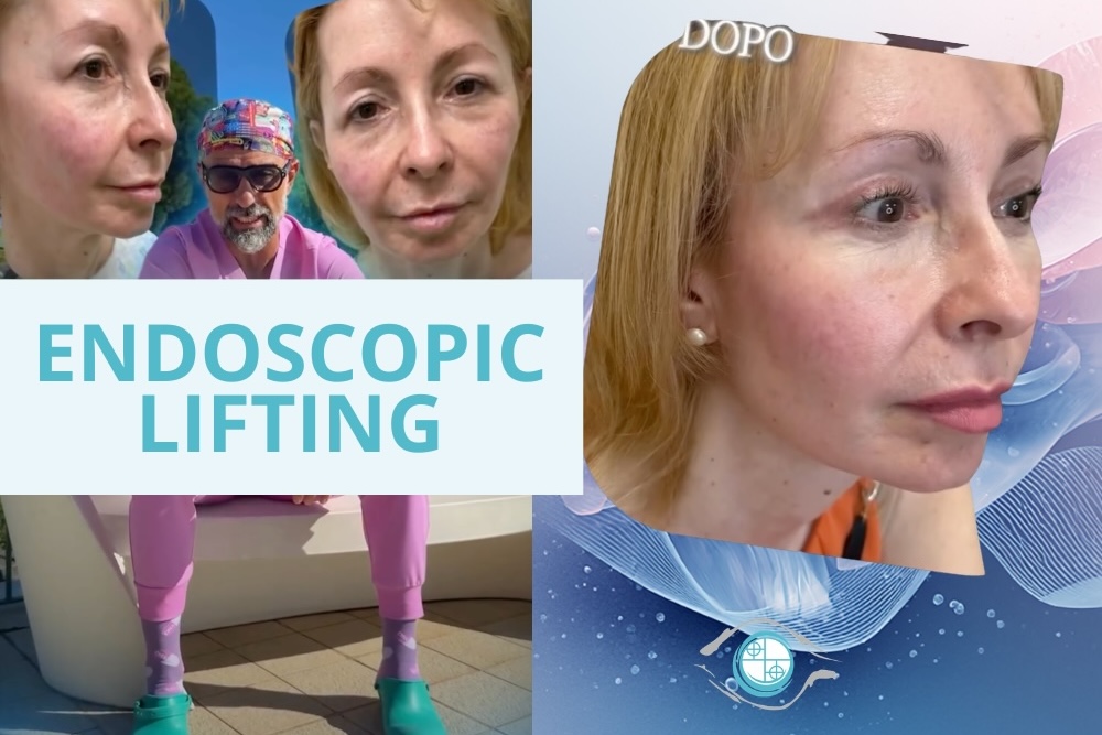 Endoscopic lift case study