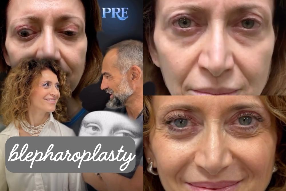 botched blepharoplasty reconstruction