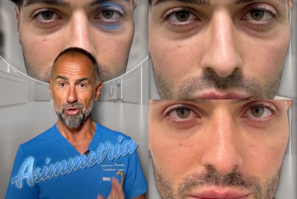 correzione asimmetria sguardo