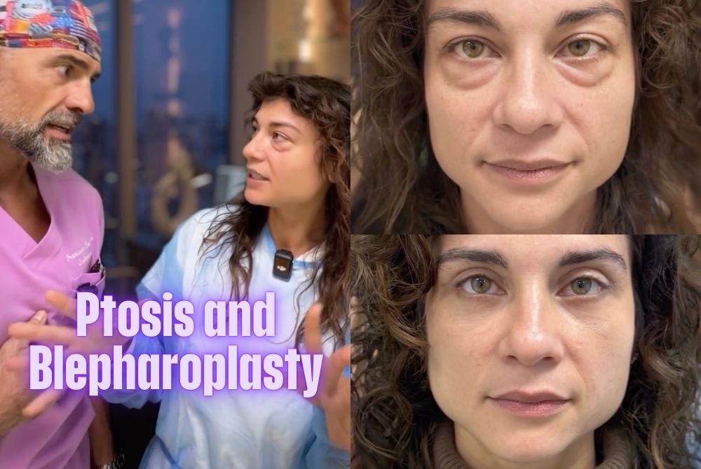 ptosis blepharoplasty case erica