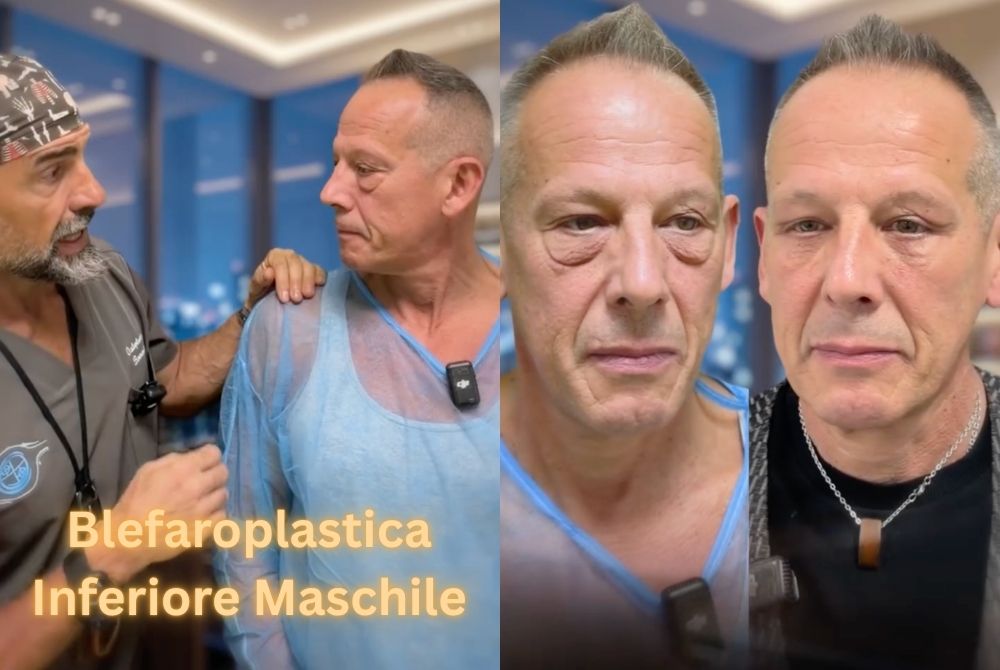 blefaroplastica inferiore uomo