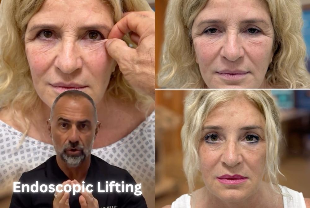 endoscopic brow lift