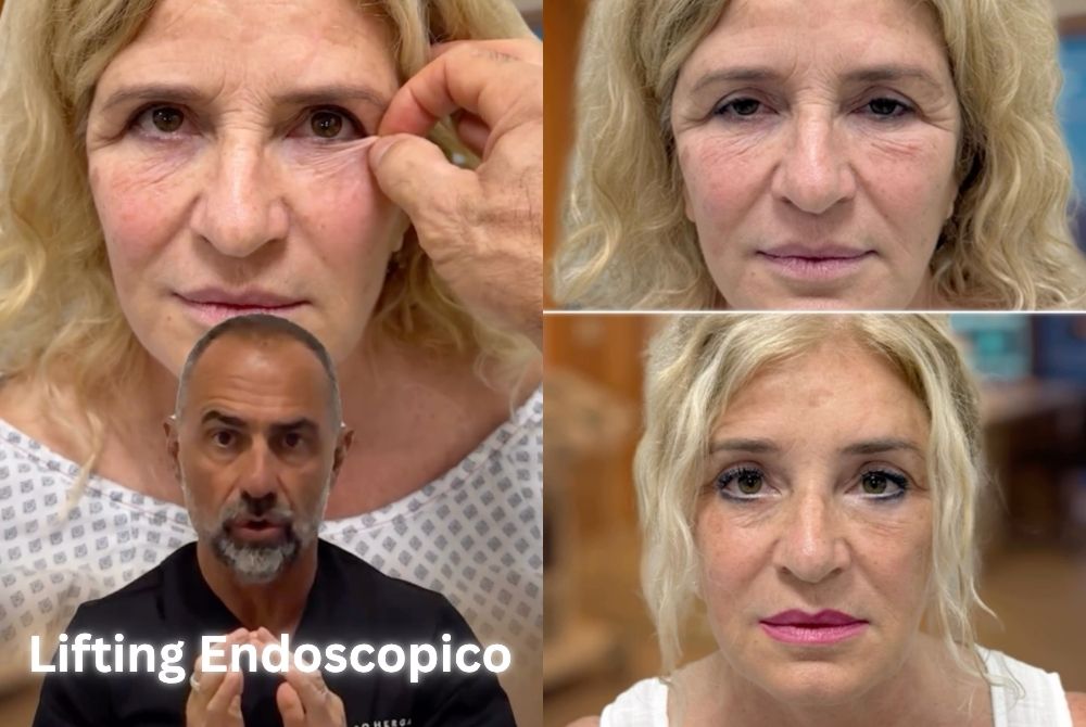 lifting endoscopico sopracciglio