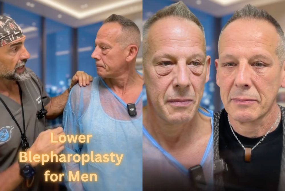 male lower blepharoplasty