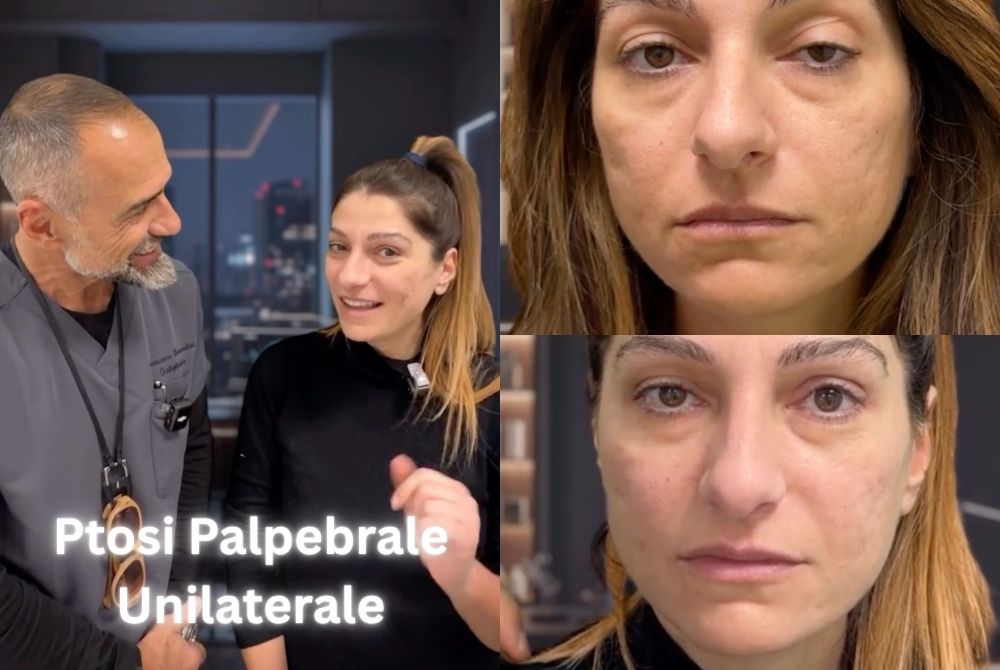 ptosi palpebrale unilaterale