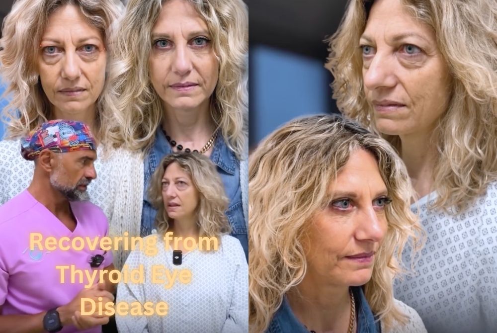 thyroid eye disease surgery