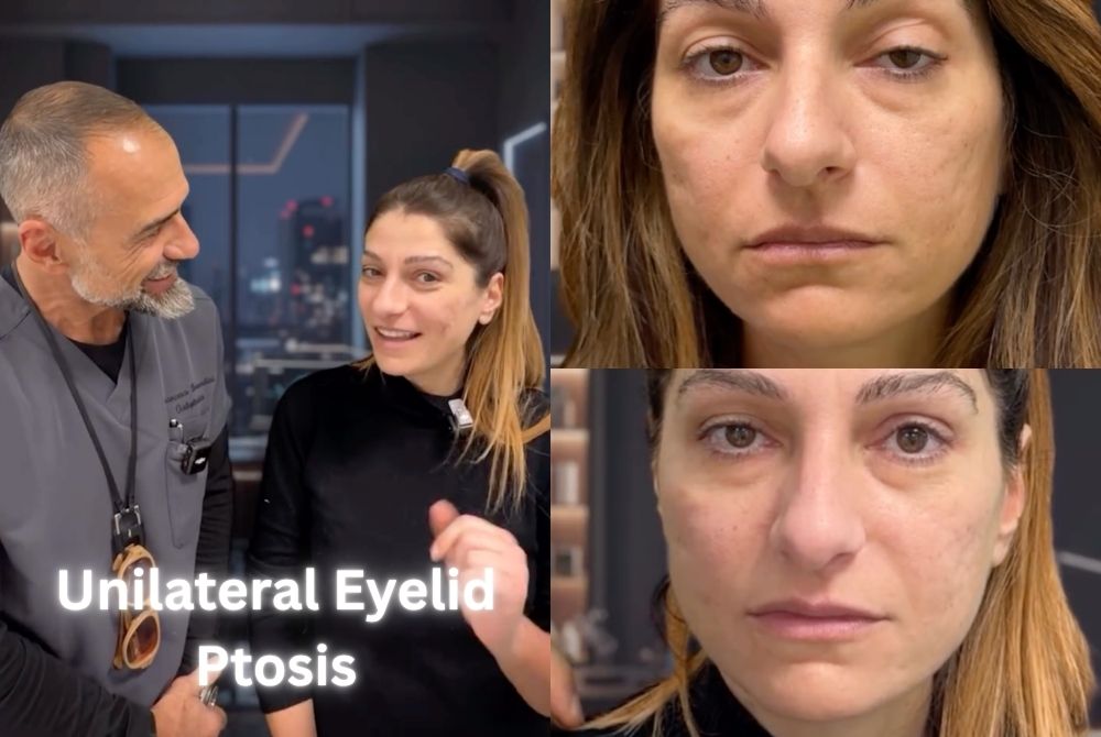 unilateral eyelid ptosis