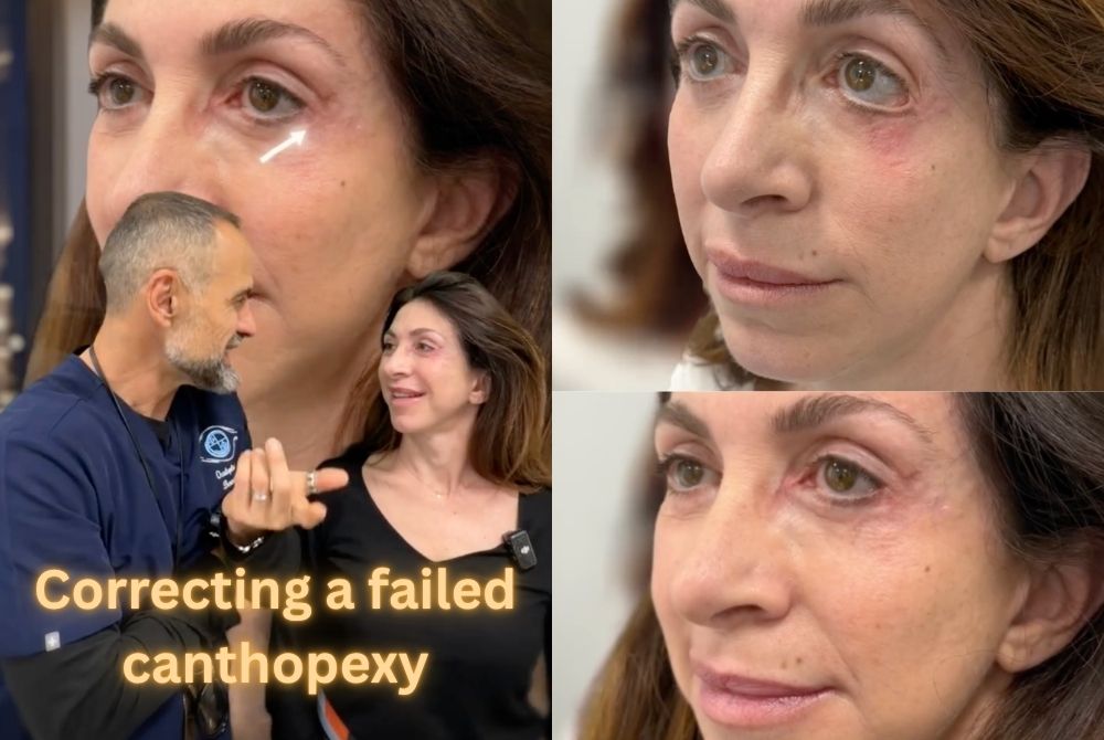 blepharoplasty canthopexy revision