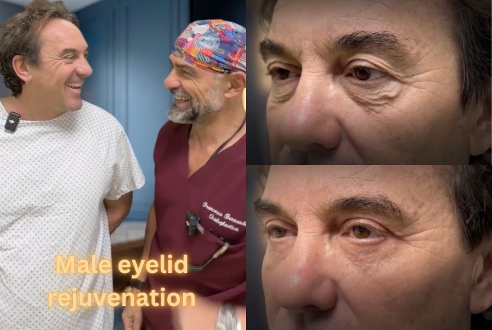 male blepharoplasty eye bags