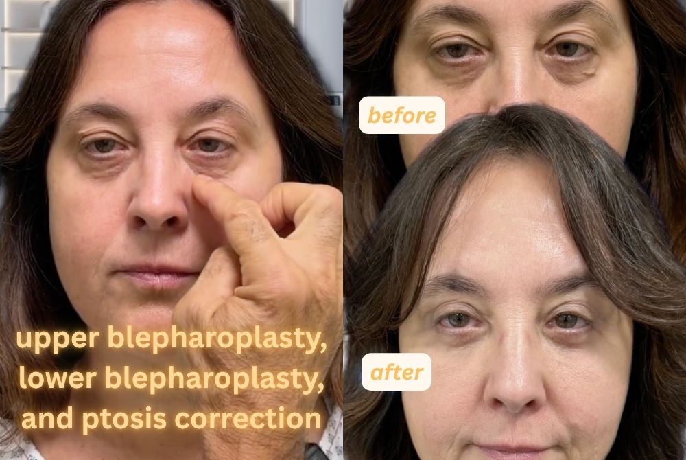 clinical case blepharoplasty ptosis