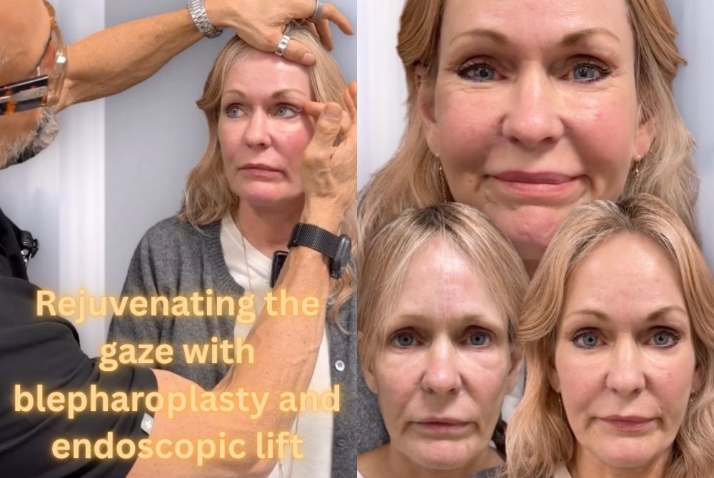 case study blepharoplasty endoscopic lift