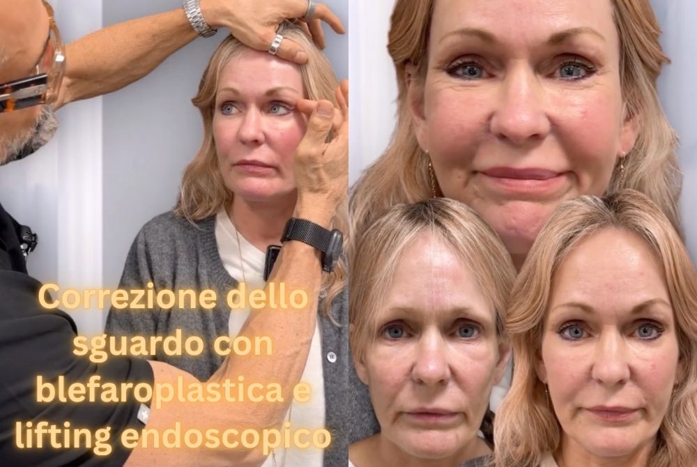 caso clinico blefaroplastica lifting endoscopico caso clinico blefaroplastica lifting endoscopico