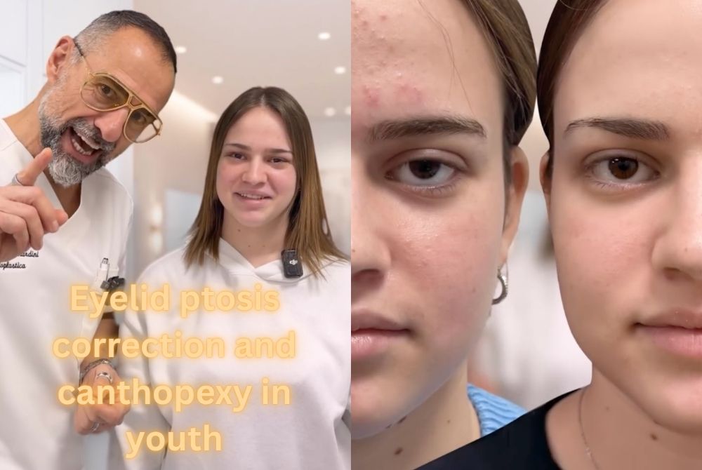 eyelid ptosis canthopexy youth