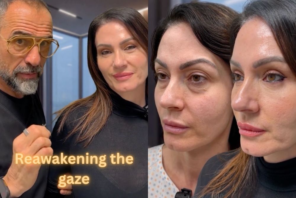 reawakening gaze blepharoplasty g point