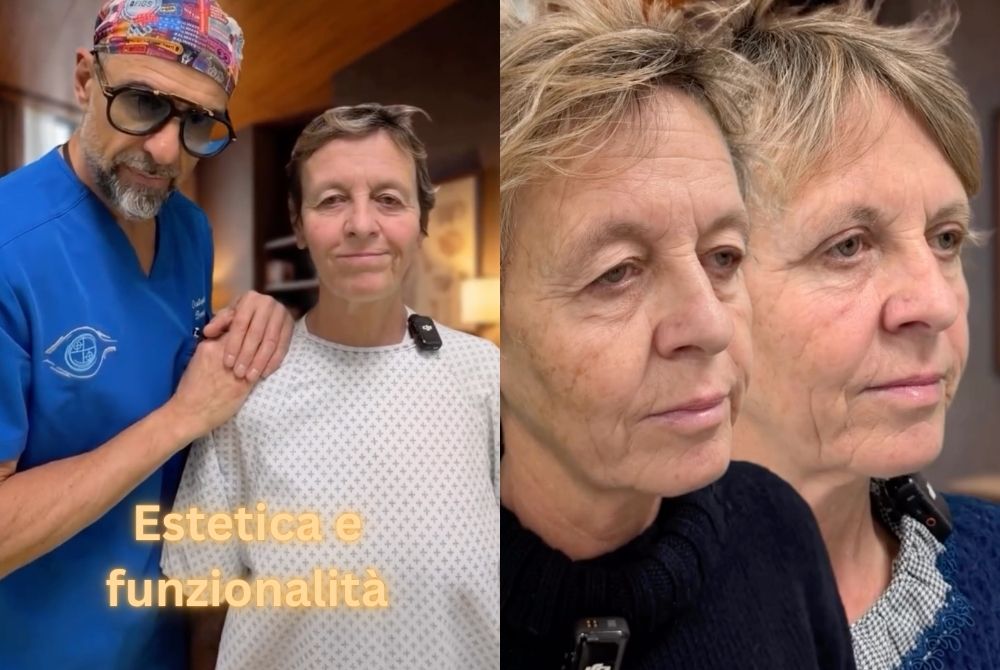 caso clinico blefaroplastica ptosi sara caso clinico blefaroplastica ptosi sara
