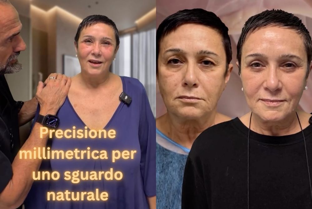 caso clinico blefaroplastica ptosi caso clinico blefaroplastica ptosi