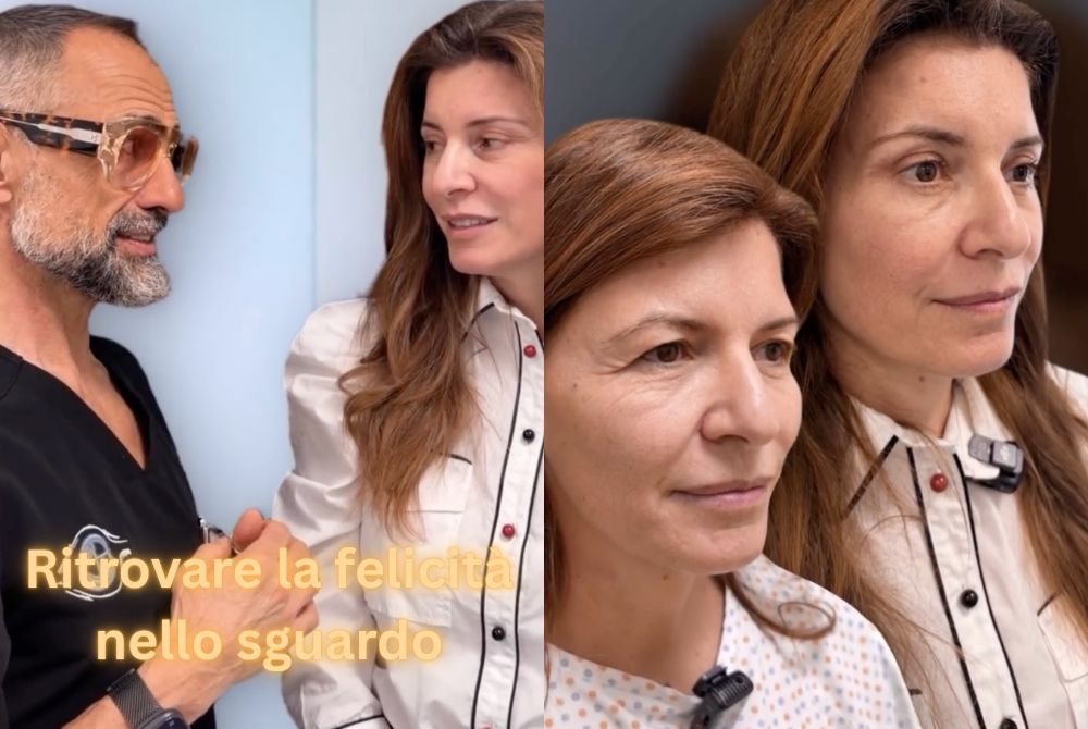 lifting endoscopico blefaroplastica lifting endoscopico blefaroplastica
