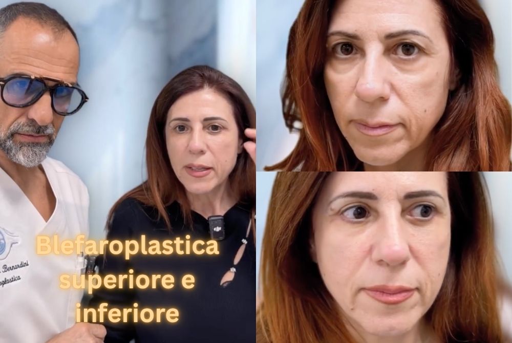 risultati blefaroplastica superiore inferiore risultati blefaroplastica superiore inferiore