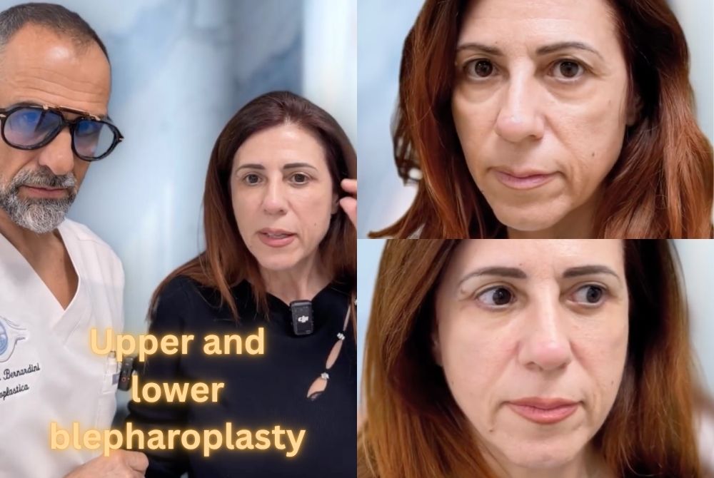 upper lower blepharoplasty results