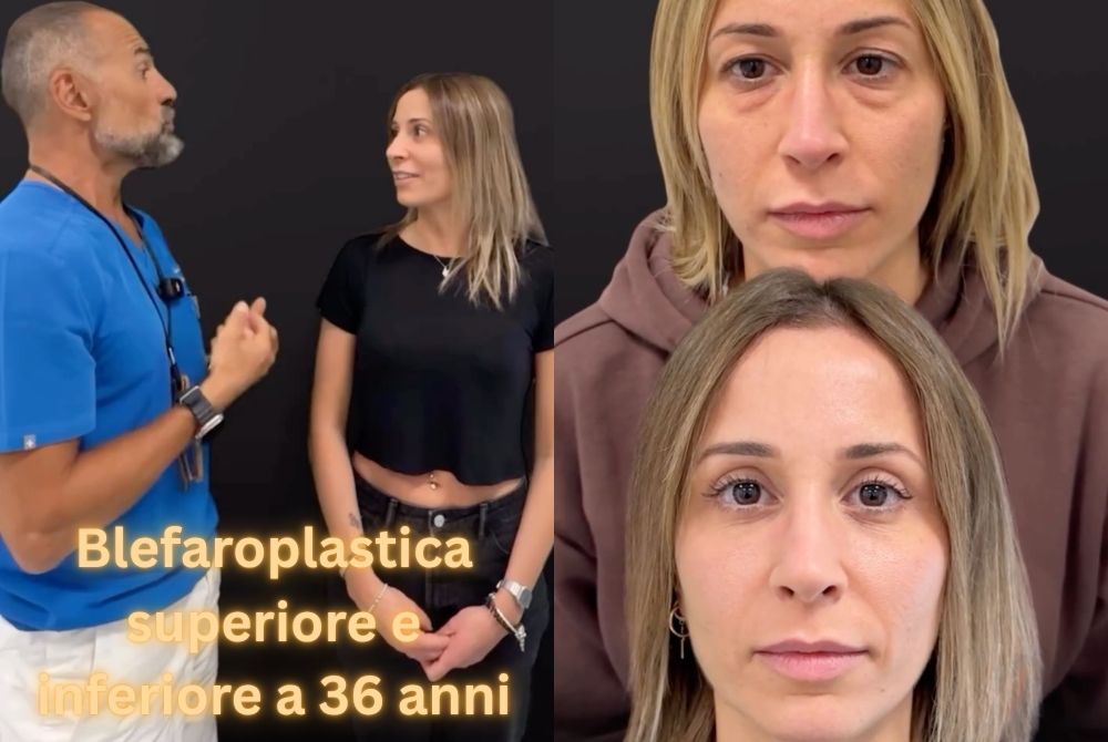 blefaroplastica completa lipofilling