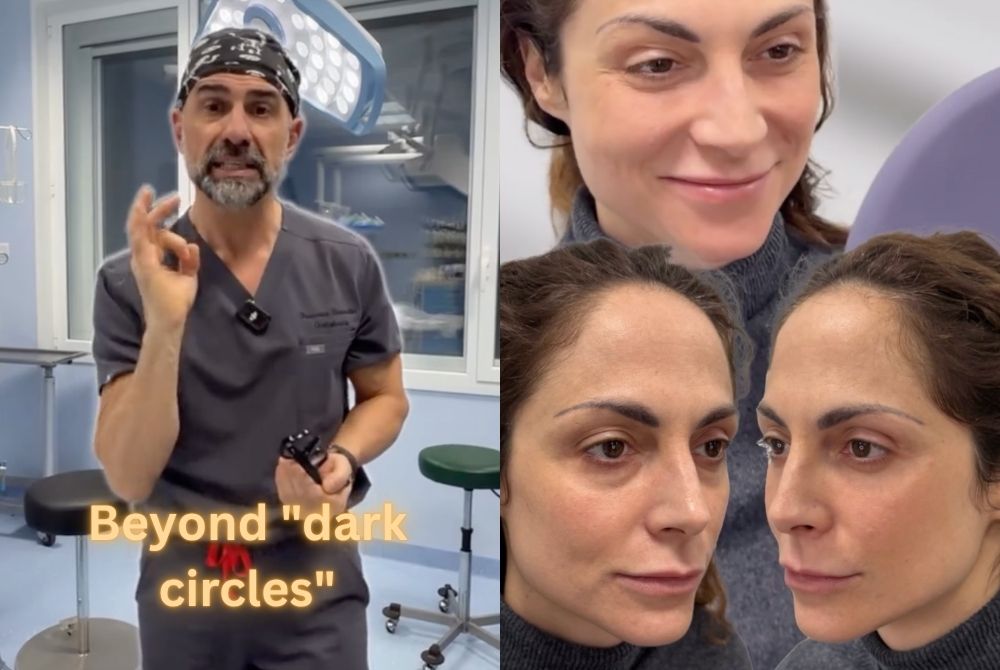 g point lift dark circles bags